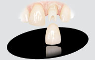 Implants Crown Zirconia Trident Dental Lab