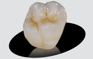 Emax Ceramic Crown Zirconia Trident Dental Lab