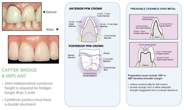 PFM Prep Guide Trident Dental