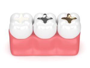 Composites in teeth