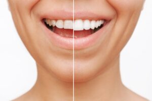 difference between normal and ceramic teeth