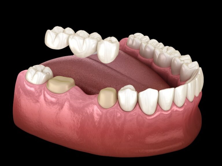 Full Contour Zirconia Dental Crowns & Bridges Laboratory