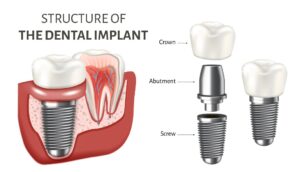 image of what a dental implant looks like