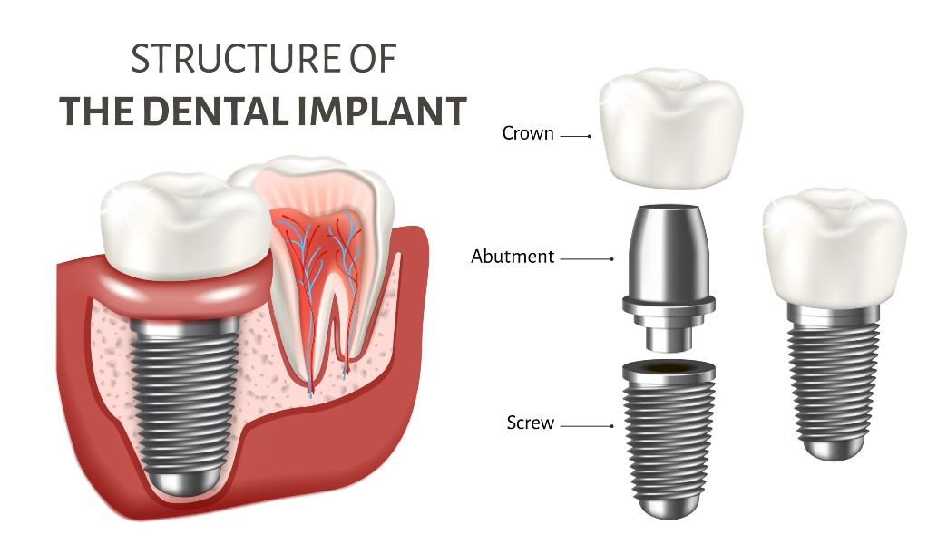 Trident Lab Dental Implants - Trident Dental Lab