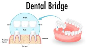 image showing how a dental bridge works