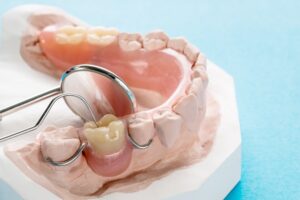 partial denture clay